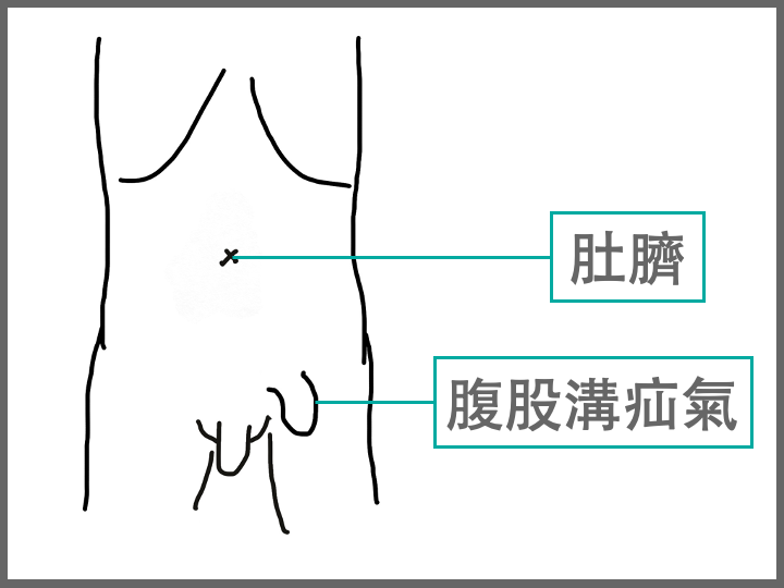 腹股溝疝氣是什麼？